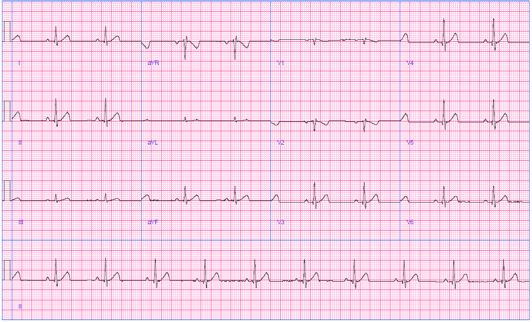 ADS1298: Background noise is over riding the original ECG signal - Data ...